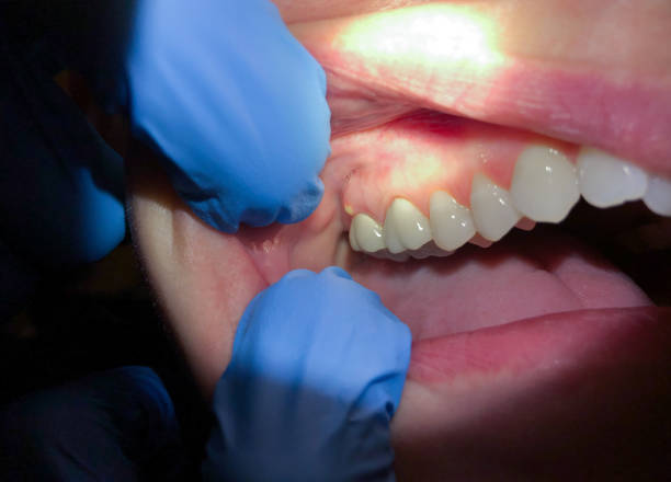 Best Emergency Dental Services for Seniors in Wellsburg, WV